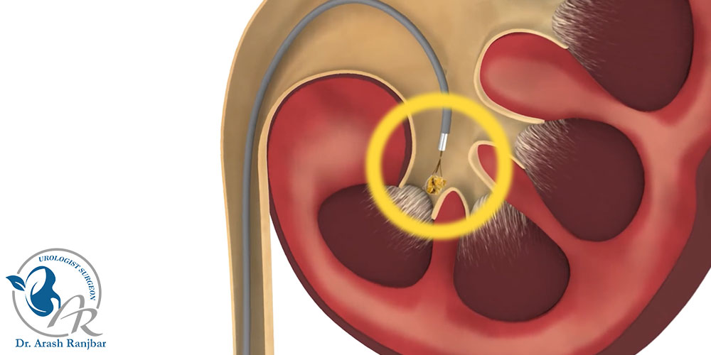 عمل جراحی ریرس