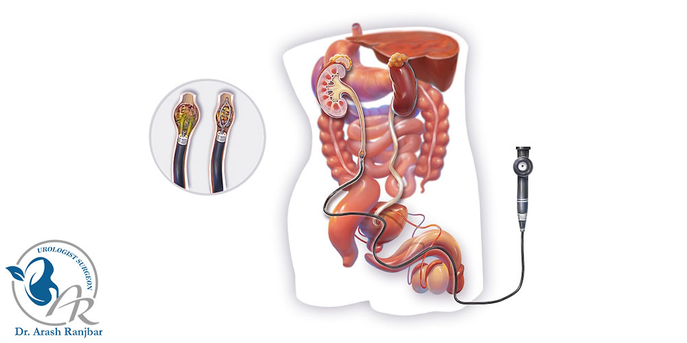 عمل لیزر سنگ کلیه