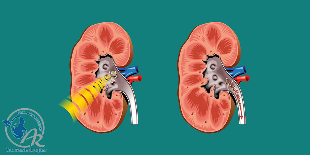 عمل لیزر سنگ کلیه