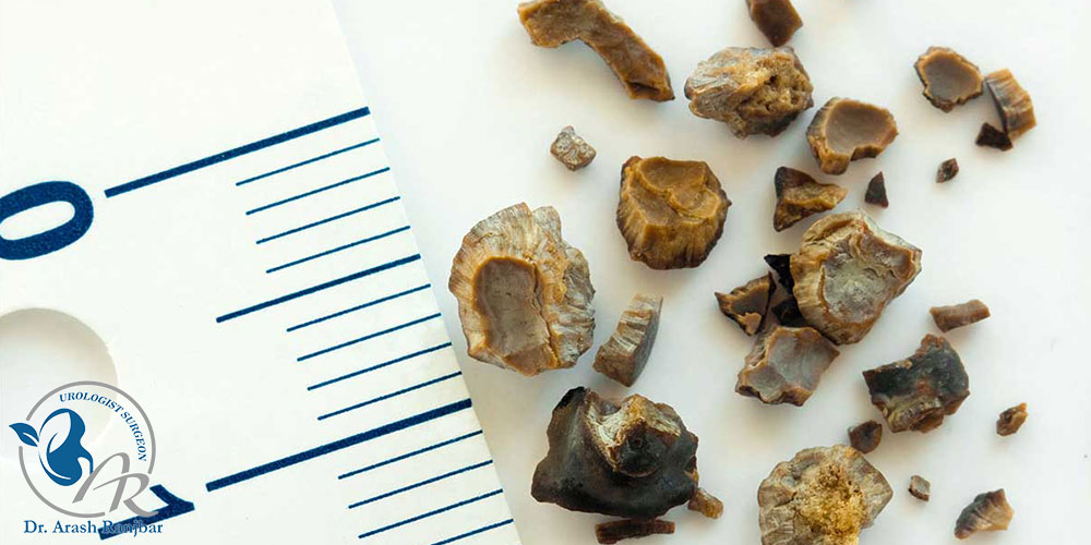 بهترین دکتر سنگ