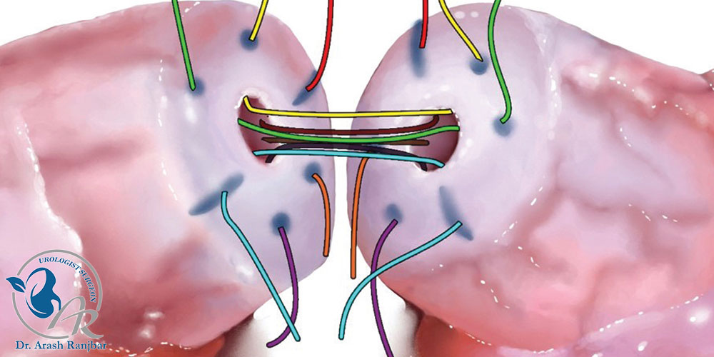 ۵ نکته مهم درباره برگشت وازکتومی