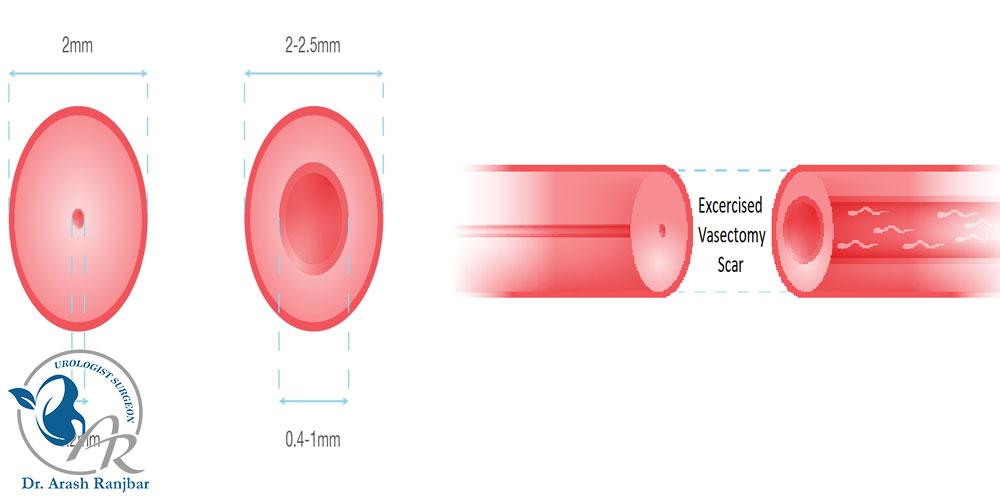 ۵ نکته مهم درباره برگشت وازکتومی