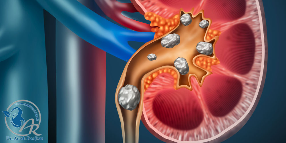 کلیههای سنگساز