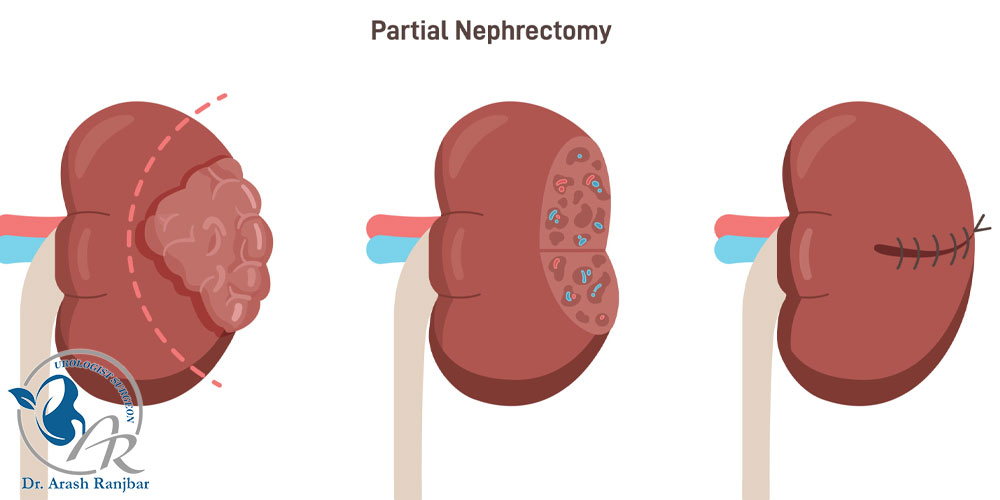 نفرکتومی کليه چيست