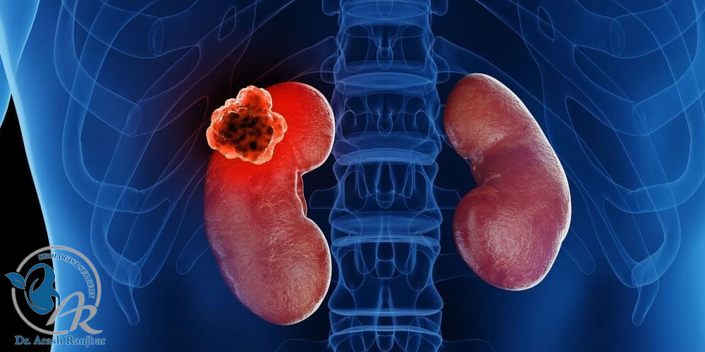 نفرکتومی کليه چيست