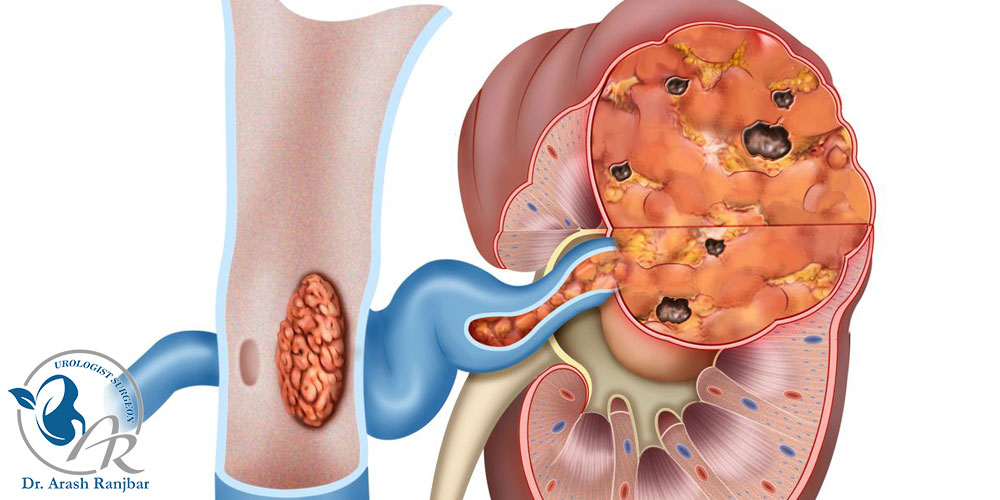 نفرکتومی کليه چيست